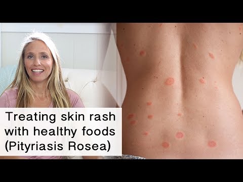 Wideo: Gdzie rozprzestrzenia się pityriasis rosea?