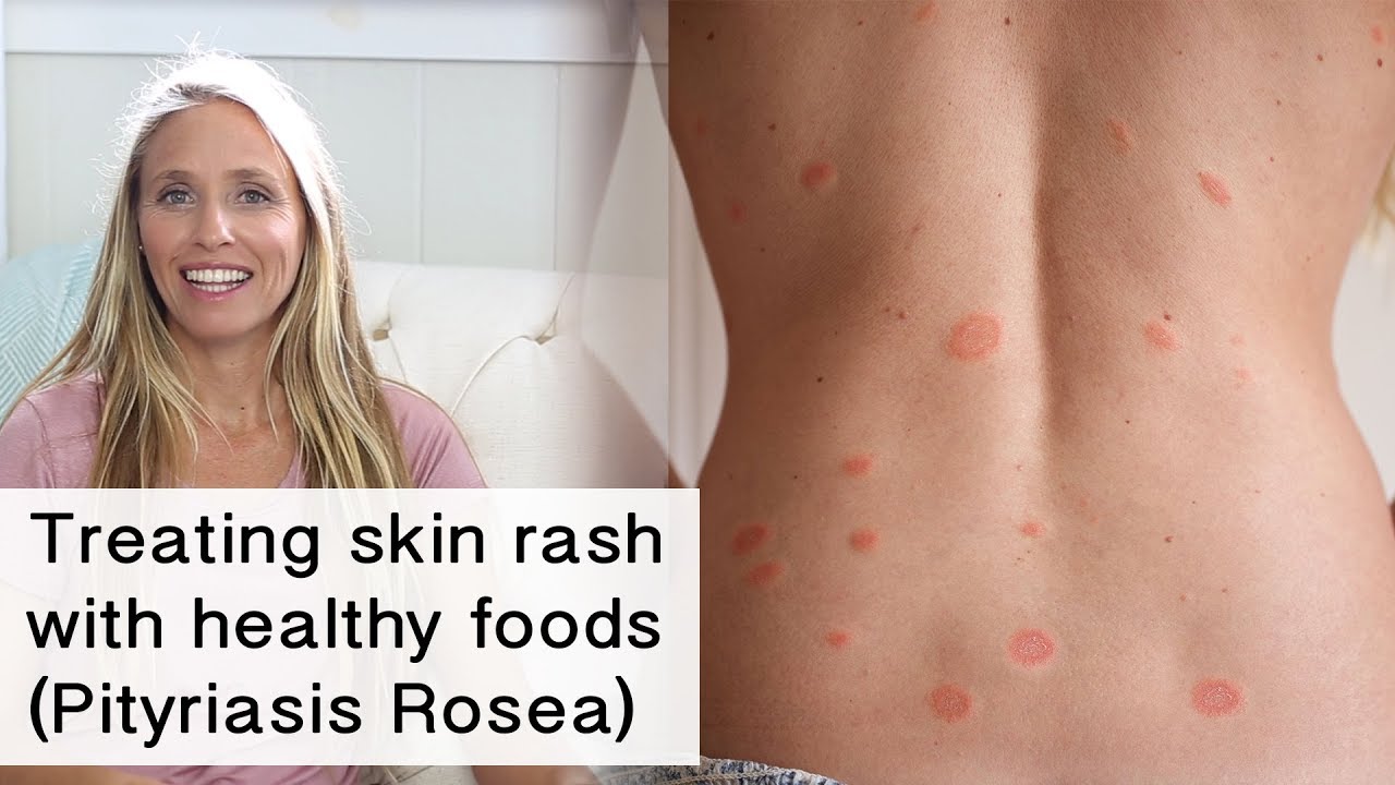 Treating Skin Rash And Inflammation With Healthy Foods Pityriasis