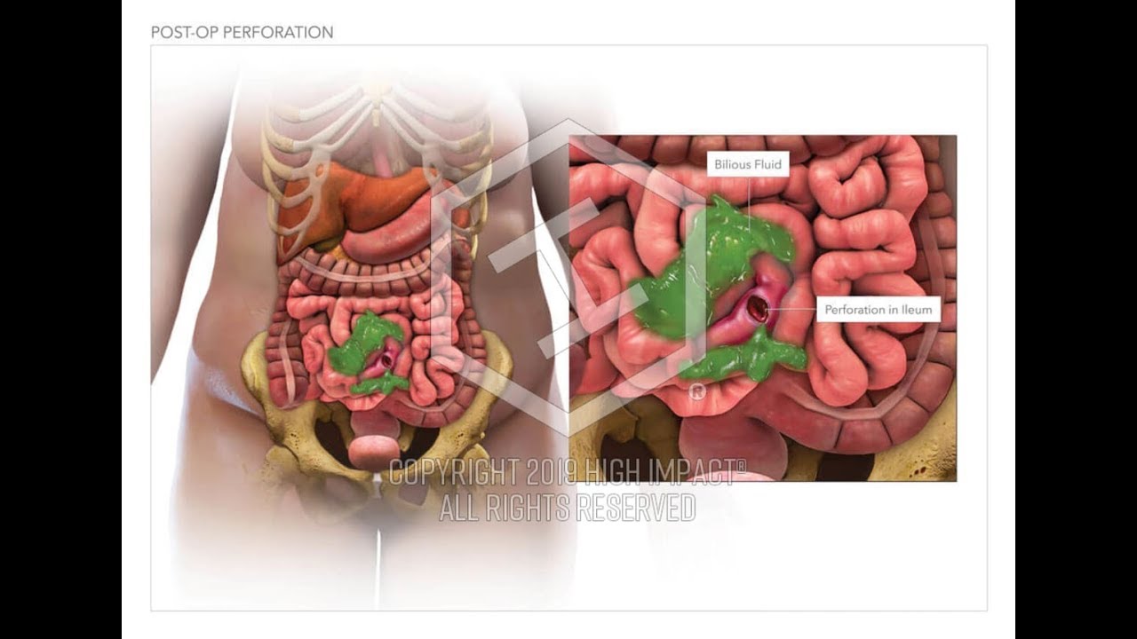 İNCE BARSAK PERFORASYONLARINA ACİL SERVİSTE YAKLAŞIM