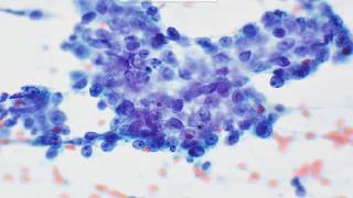 Cervical LN FNA: Metastatic nasopharyngeal carcinoma