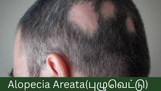 Alopecia Areata(புழுவெட்டு) | Naturopathy Treatment | Punarjeevan Ayush Nature Cure Center