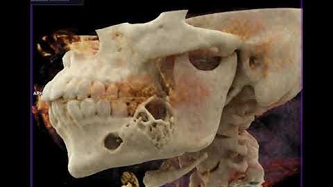 Ameloblastoma with Cinematic Rendering