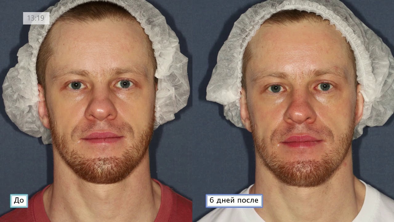 Первый опыт применения Legend Pro+ в России. Возможности и перспективы новой методики.