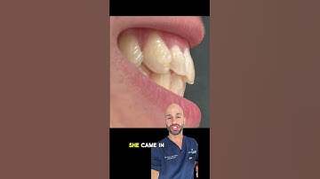 Ways to fix overbite with Invisalign.