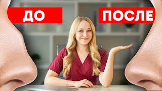 Как Убрать Горбинку на Носу: Все Способы
