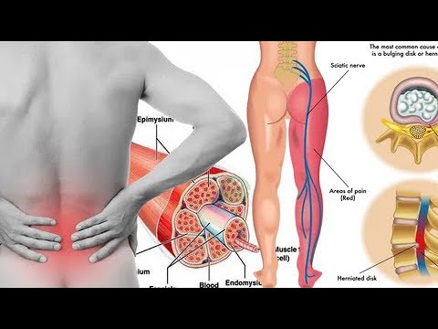 Боль и онемение в ноге при грыже диска   Pain and numbness in the leg with disc herniation