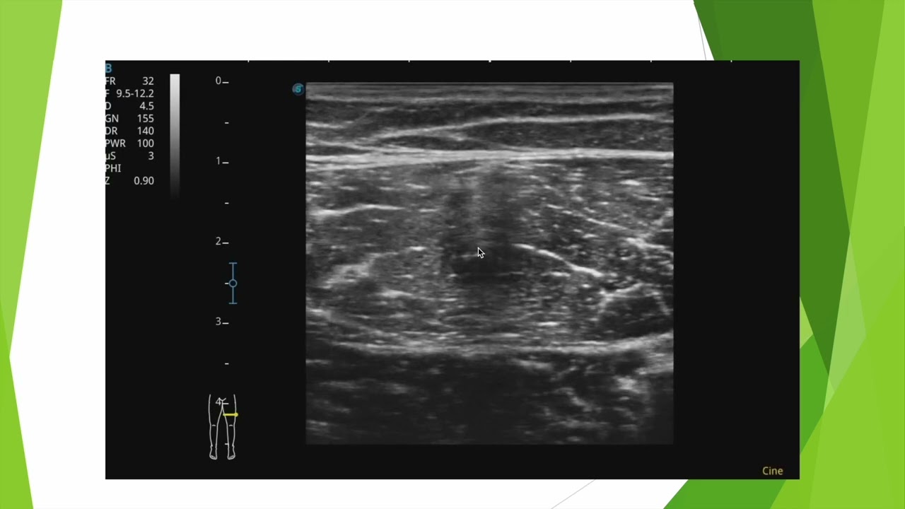 échographie du droit fémoral