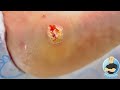 STUBBORN FOOT WART FINALLY GETTING CUT OUT!!! ***SURGICAL WART REMOVAL***