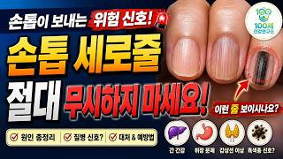 손톱의 검은 세로줄, 그냥 넘기면 안 되는 이유