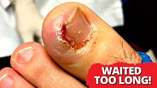 Permanent Ingrown Nail Removal After Multiple Ingrown Procedures (SATISFYING)