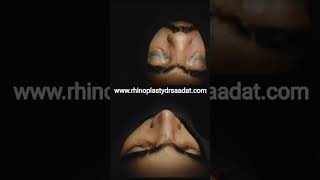 Enhance facial harmony Boost confidence Improve breathing #NoseReshaping #CrookedNose #DrSaadatUllah