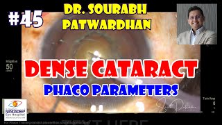 Commented 45 phaco parameters for hard cataract 4K Dr Sourabh Patwardhan Constellation phaco