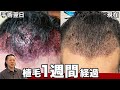 【植毛1週間】驚きの頭皮状態!術後のシャンプーで気をつけること【手術経過】