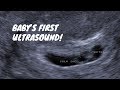 Baby's First Ultrasound! 6 Weeks Pregnant