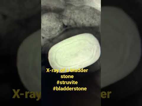 Bladder stone x-ray, this thing is huge!