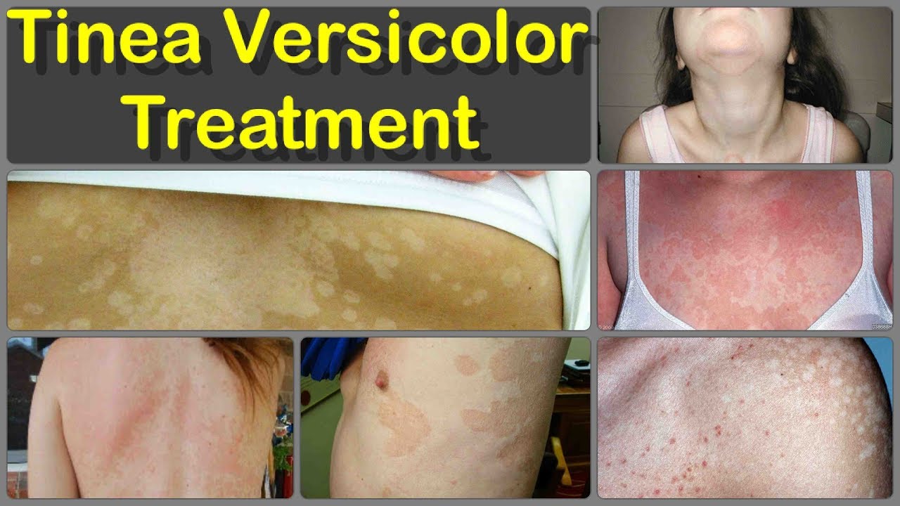 best oral medication for tinea versicolor