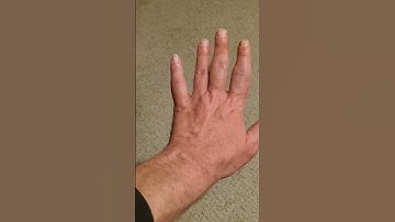 Swollen Fingers & Joints: Trigger Finger (and a cute cat video too) :) #triggerfinger