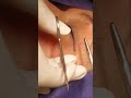 Excision of Facial Nevus Near the Eye
