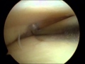 Arthroscopy on melinas left knee