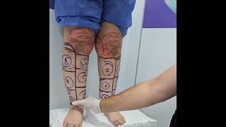 نحت الساقين لعلاج حالة ليبديما درجة ثالثة في الساقين وذمة_شحمية