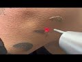 Laser tattoo removal upper arm in dark skin 