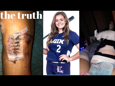 acl surgery full recovery | my story & the reality