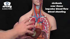 Esophageal Varices Animation Nursing Overview