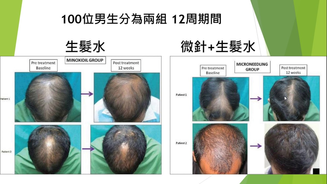 驚人的生髮研究報告微針 生髮水minoxidil 4x的效果你生髮水使用對了嗎 Youtube