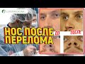 Выпрямить нос после перелома. 👃😤Операция. Хирург Тигран Алексанян. Риносептопластика 💡🔞🔞🔞