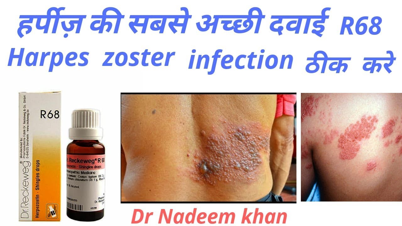 R68 homeopathic medicine for herpes हरपीज़ YouTube