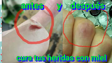 ¿Qué tipo de miel es buena para cicatrizar las heridas?