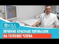 💉 💊 Лечение красных пятнышек на головке члена  Клинический случай №369