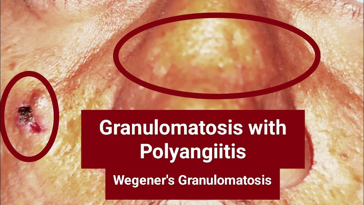 Granulomatosis with Polyangiitis or Wegener's Granulomatosis - A Real ...