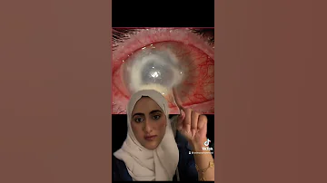 مخاطر الاستخدام الخاطئ للعدسات اللاصقة 