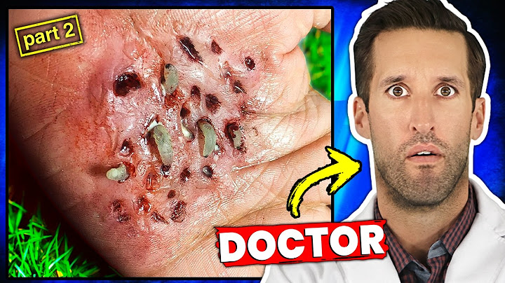 The Most Disturbing Parasites Found Inside Humans #2