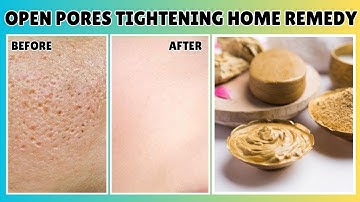 7 Days Challenge : Get Rid of *OPEN PORES, LARGE PORES, CLOGGED PORES* Permanently 💕 Homemade Pack ✨