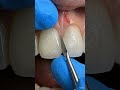Dental Bonding: Step-by-Step Transformation 💎 #dentist #dentalcare #smiledesigndental