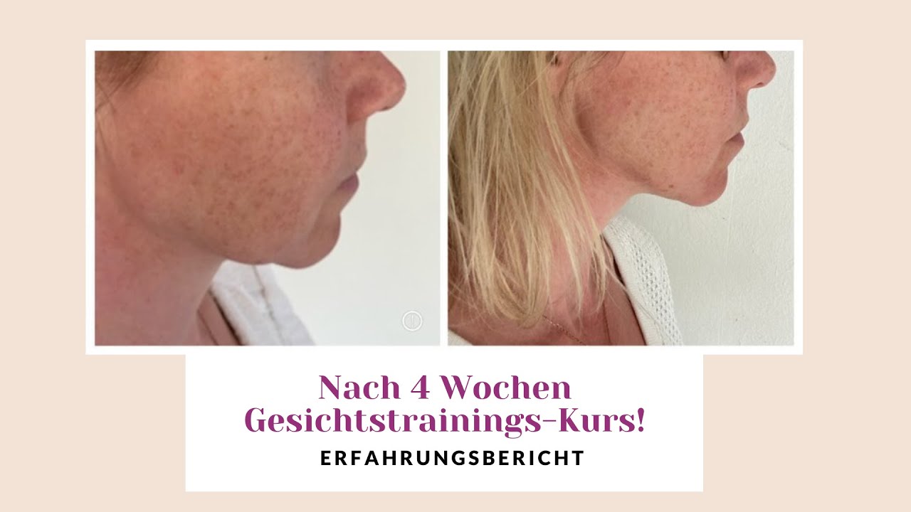 Wangen geliftet nach 4 Wochen! Vorher-Nachher-Erfahrungsbericht