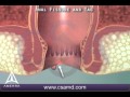 What is an anal fissure 3d animation