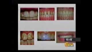 Fluorosis dental