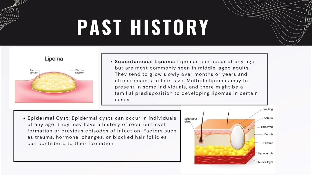subcutaneous-lipoma-vs-epidermal-cyst-youtube