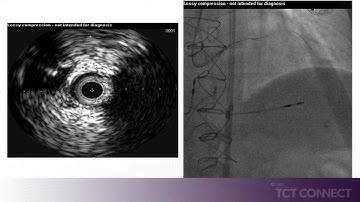 Complex CTO with Proximal Cap Ambiguity solved using IVUS Guided Puncture of the Proximal Cap
