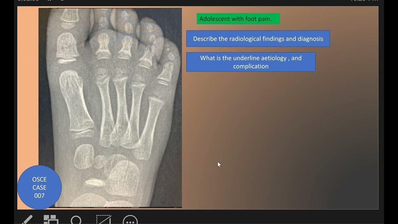 OSCE Case 007 Kohler Disease YouTube