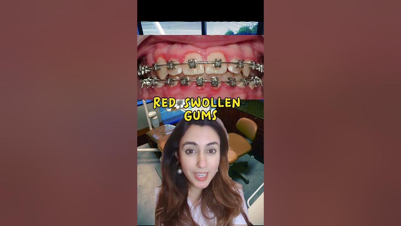 Vaping With Braces or Invisalign? 🦷👻🌬️ shorts YouTube