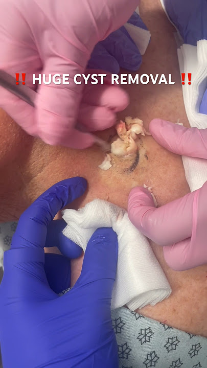 EPIC cyst removal! 🤯 #cystpoping #extraction #oddlysatisfying #satisfying #pop