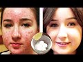 Acne Remedies That Actually Works | បំបាត់មុននិងស្នាមមុនលឿន| Best Way To Get Rid Of Acne | Mom Share