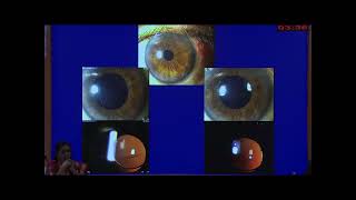 AIOC 2026   GP190   Eyeshala   Session 2   Cataract, Glaucoma, Oncology