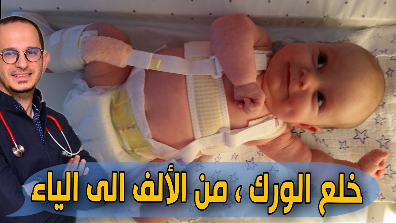 خلع الورك - كل ما تحتاج معرفته عن خلع الولادة