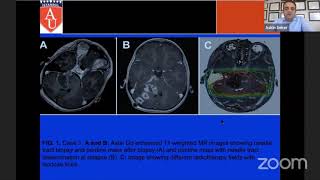 Surgical Approaches to Diffuse Pontine Gliomas- Askin Seker