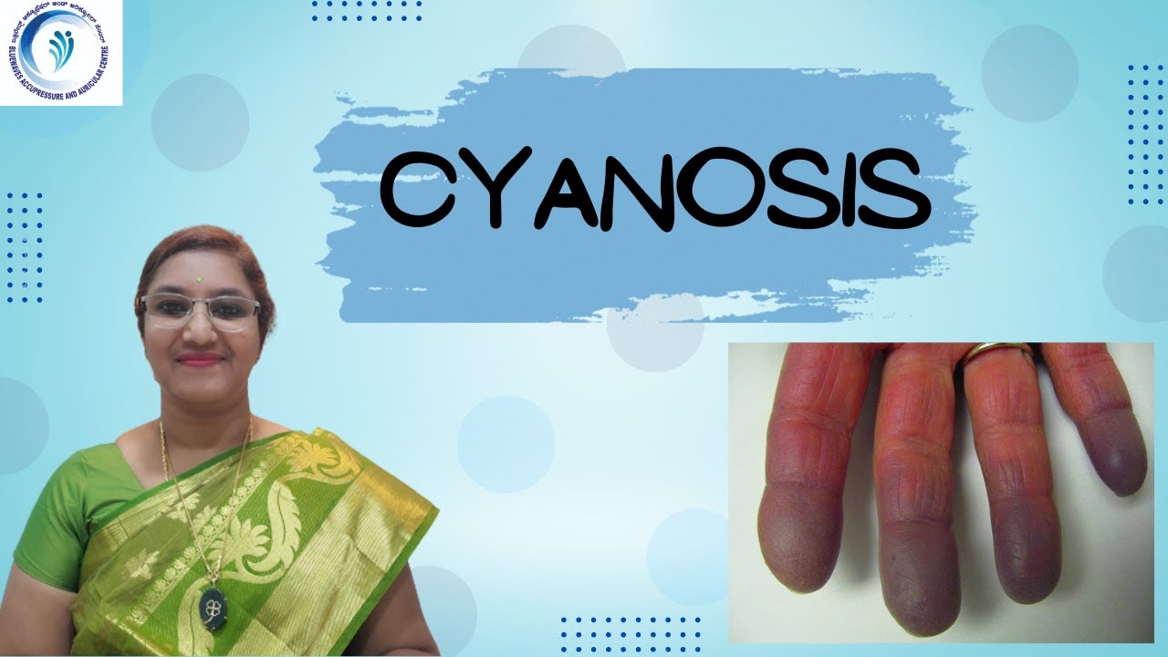 Single Point Acupressure Treatment For Cyanosis (In Kannada) YouTube